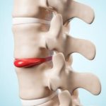 Hrnia_de_Disco_Crdito_Shutterstock_1145606846